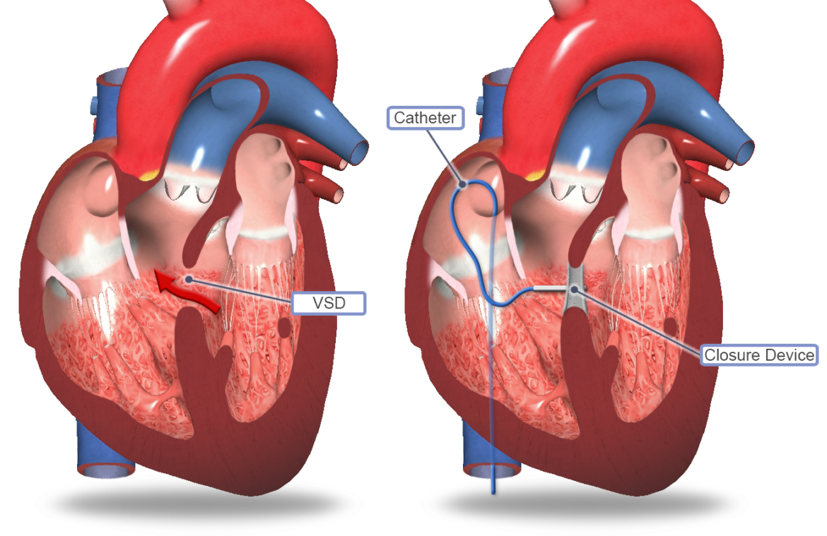 What is an VSD ( Ventricular septal defect ) ?